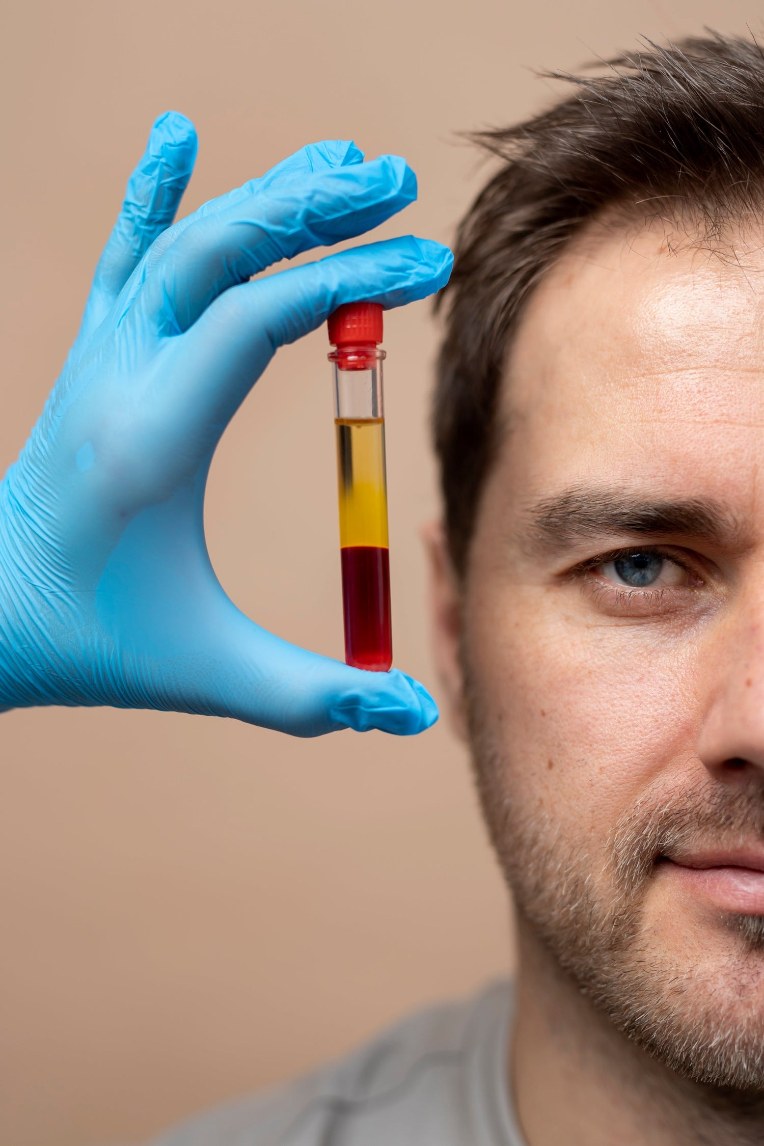 PRP with microneedling